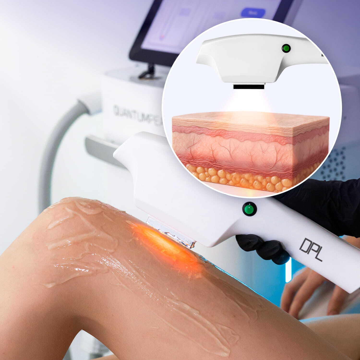 Połączenie IPL i RF dla wszechstronnych rozwiązań estetycznych