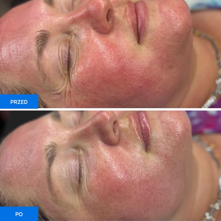Skóra skłonna do niedoskonałości Zanieczyszczenia i zaburzona równowaga sebum